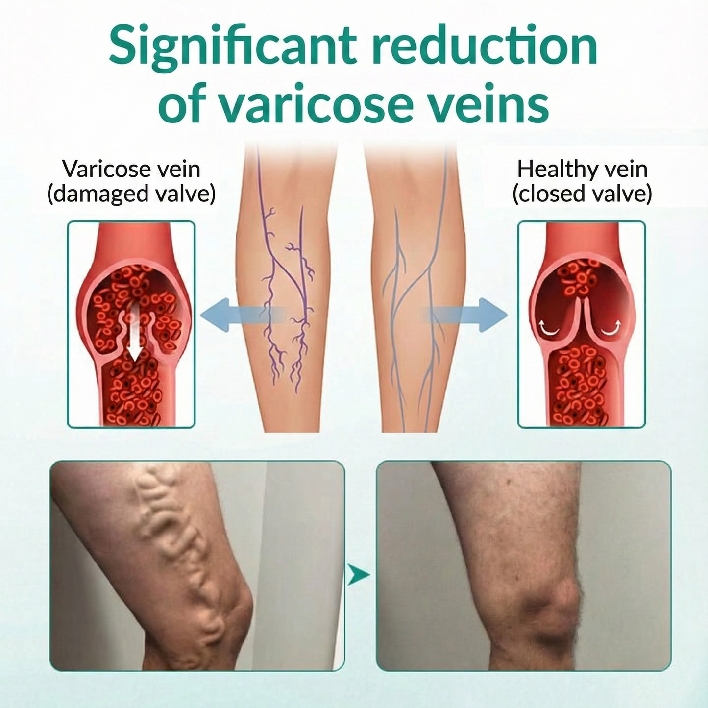 LOVILDS® LegRenew Patch for Varicose Veins Supports Vein Health & Helps Reduce Swelling — No Surgery