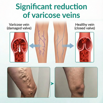 LOVILDS® LegRenew Patch for Varicose Veins Supports Vein Health & Helps Reduce Swelling — No Surgery