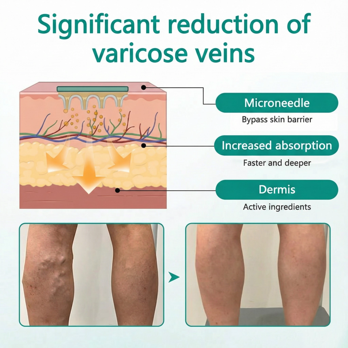 LOVILDS® LegRenew Patch for Varicose Veins Supports Vein Health & Helps Reduce Swelling — No Surgery