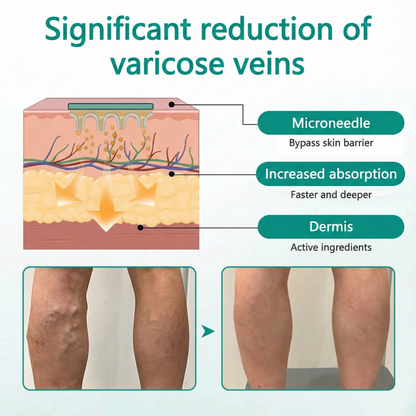 LOVILDS® LegRenew Patch for Varicose Veins Supports Vein Health & Helps Reduce Swelling — No Surgery