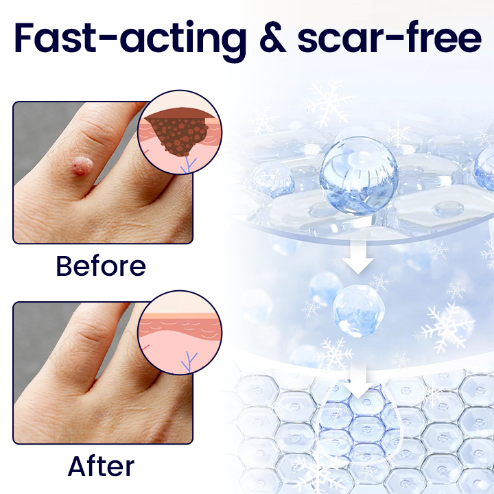 BBOJI® WartErase Cryo Freeze Spray